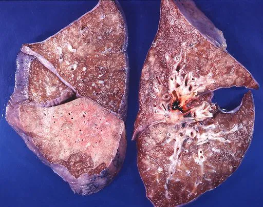 pneumonia